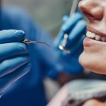 Tooth Extractions