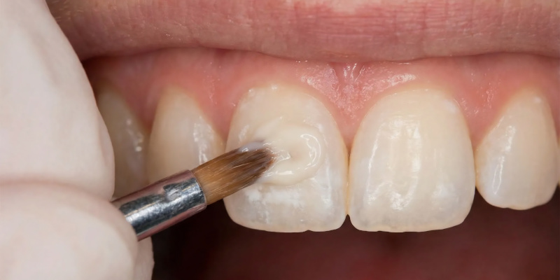 Composite Bonding in Salem, New Hampshire