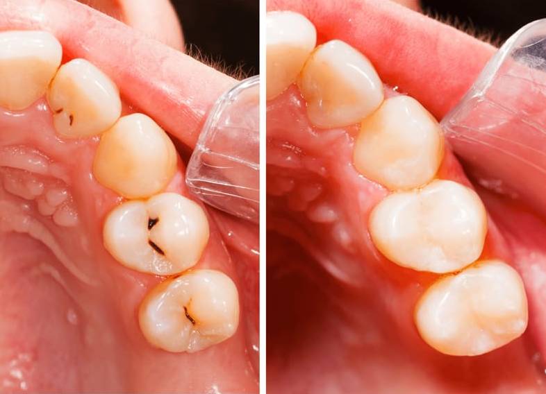 Composite Fillings