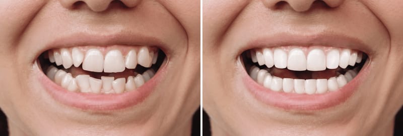 Clear Aligners, Salem, NH