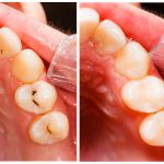 Close-up of two side-by-side views of lower molars in a mouth; left shows a cavity, right shows a restored tooth after filling.