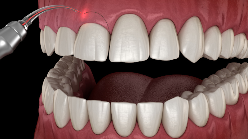 Close-up of a dental laser gum tissue between the upper front teeth.