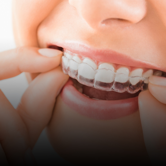 Clear Aligners