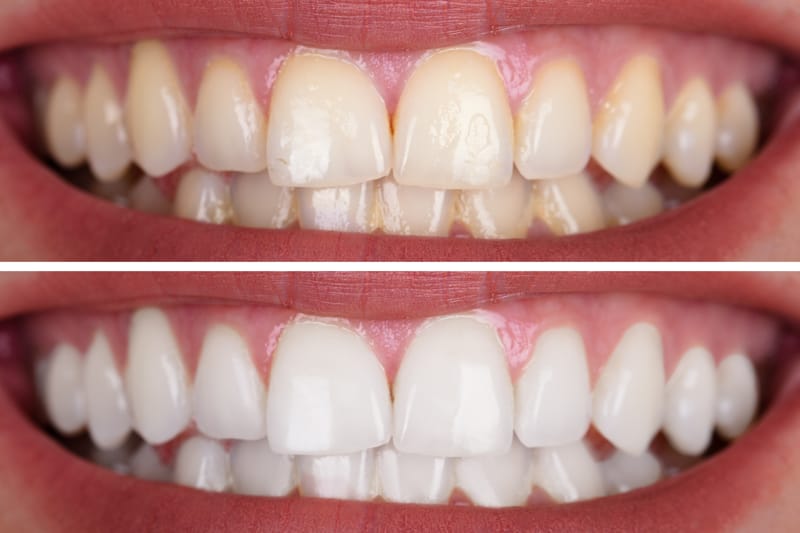 Teeth Whitening, Salem, NH