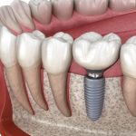 Dental Implants