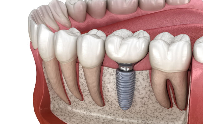 Dental Implants