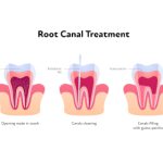 Root Canals