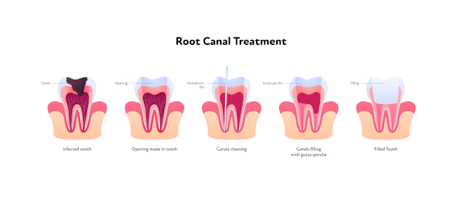 Root Canals