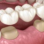 Dental Bridges