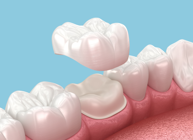Porcelain Crowns in Salem, New Hampshire